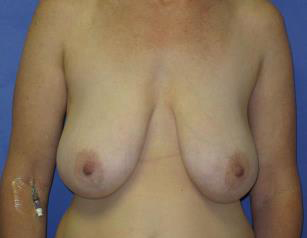 Breast Lift Before & After Patient #7389