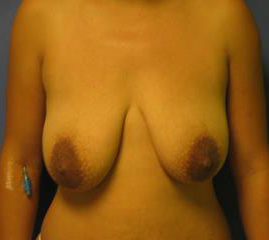 Breast Lift Before & After Patient #7397