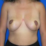 Breast Lift Before & After Patient #7397