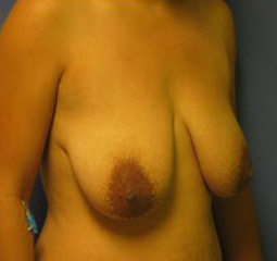 Breast Lift Before & After Patient #7397