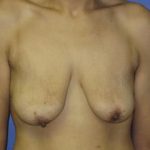 Breast Lift with Augmentation Before & After Patient #7402