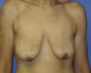 Breast Lift with Augmentation Before & After Patient #7402