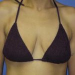 Breast Lift with Augmentation Before & After Patient #7402