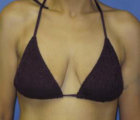 Breast Lift with Augmentation Before & After Patient #7402