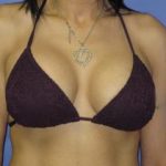 Breast Lift with Augmentation Before & After Patient #7402