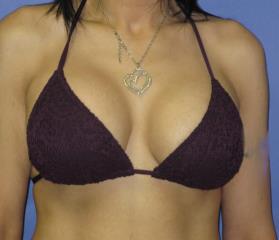 Breast Lift with Augmentation Before & After Patient #7402