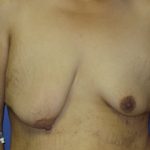 Breast Lift with Augmentation Before & After Patient #7413