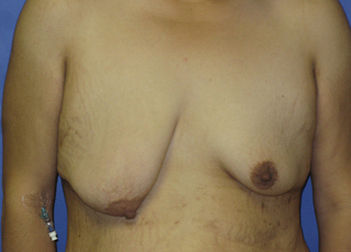 Breast Lift with Augmentation Before & After Patient #7413