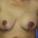 Breast Lift with Augmentation Before & After Patient #7413