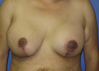 Breast Lift with Augmentation Before & After Patient #7413