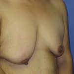 Breast Lift with Augmentation Before & After Patient #7413