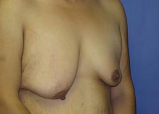 Breast Lift with Augmentation Before & After Patient #7413