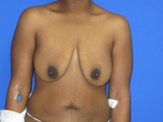 Breast Lift with Augmentation Before & After Patient #7428