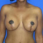 Breast Lift with Augmentation Before & After Patient #7428
