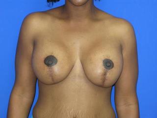 Breast Lift with Augmentation Before & After Patient #7428