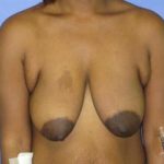 Breast Lift with Augmentation Before & After Patient #7442