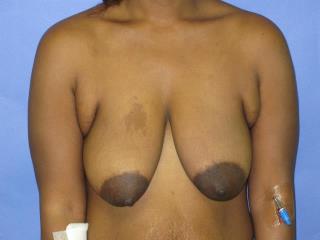 Breast Lift with Augmentation Before & After Patient #7442