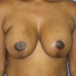 Breast Lift with Augmentation Before & After Patient #7442