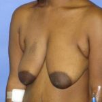 Breast Lift with Augmentation Before & After Patient #7442