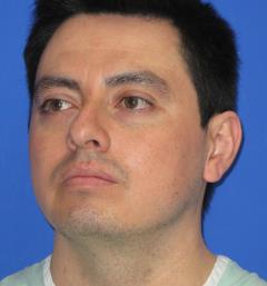Buccal Fat Pad Before & After Patient #1177