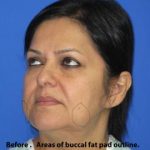 Buccal Fat Pad Before & After Patient #1187