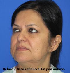 Buccal Fat Pad Before & After Patient #1187
