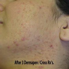 Micro-needling Before & After Patient #1016