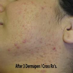 TCA Cross Before & After Patient #1016