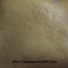 Micro-needling Before & After Patient #1026
