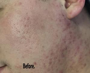 TCA Cross Before & After Patient #1036