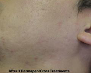 Micro-needling Before & After Patient #1036