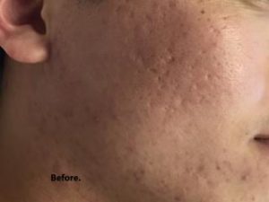 Micro-needling Before & After Patient #1042