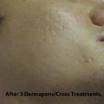 TCA Cross Before & After Patient #1042
