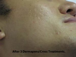 Micro-needling Before & After Patient #1042