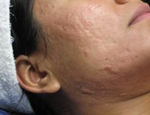 Micro-needling Before & After Patient #1050