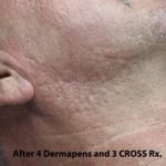TCA Cross Before & After Patient #1056