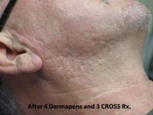 TCA Cross Before & After Patient #1056