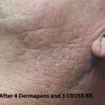 TCA Cross Before & After Patient #1056