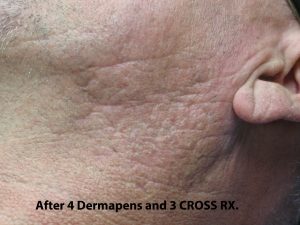 TCA Cross Before & After Patient #1056