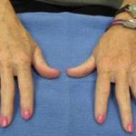 Micro-needling Before & After Patient #1077