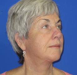 Facelift Before & After Patient #1133