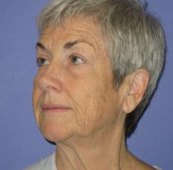 Facelift Before & After Patient #1133