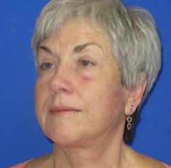 Facelift Before & After Patient #1133