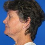 Facelift Before & After Patient #1147