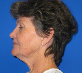 Facelift Before & After Patient #1147