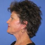 Facelift Before & After Patient #1147