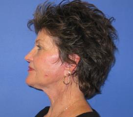 Facelift Before & After Patient #1147