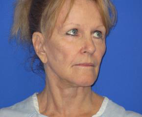 Facelift Before & After Patient #1155