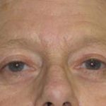 Facelift Before & After Patient #1009