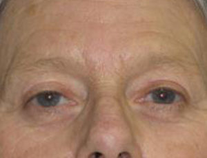 Facelift Before & After Patient #1009